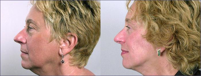 Facelift Case 5 Before & After View #2 | Paramus, New Jersey | Parker Center for Plastic Surgery
