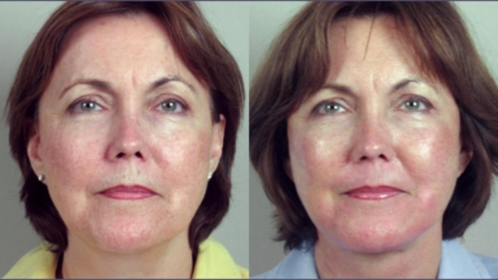 Facelift Case 7 Before & After View #1 | Paramus, New Jersey | Parker Center for Plastic Surgery