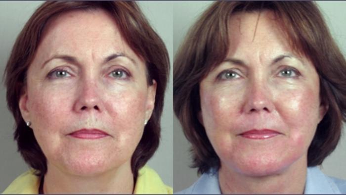 Facelift Case 7 Before & After View #1 | Paramus, New Jersey | Parker Center for Plastic Surgery