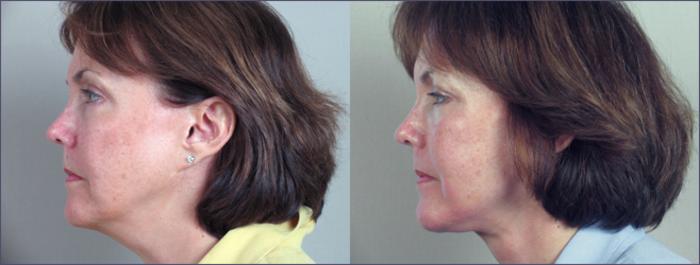 Facelift Case 7 Before & After View #2 | Paramus, New Jersey | Parker Center for Plastic Surgery