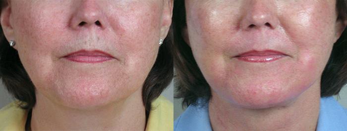 Facelift Case 7 Before & After View #3 | Paramus, New Jersey | Parker Center for Plastic Surgery