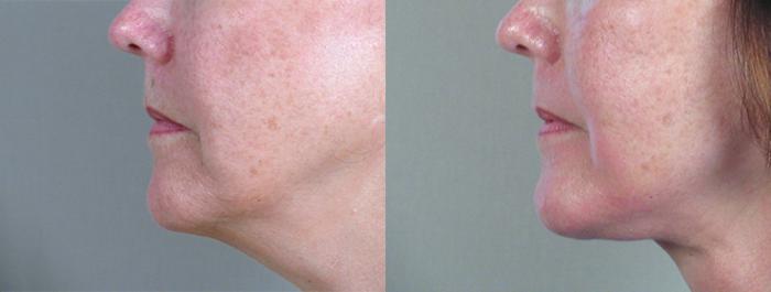 Facelift Case 7 Before & After View #4 | Paramus, New Jersey | Parker Center for Plastic Surgery