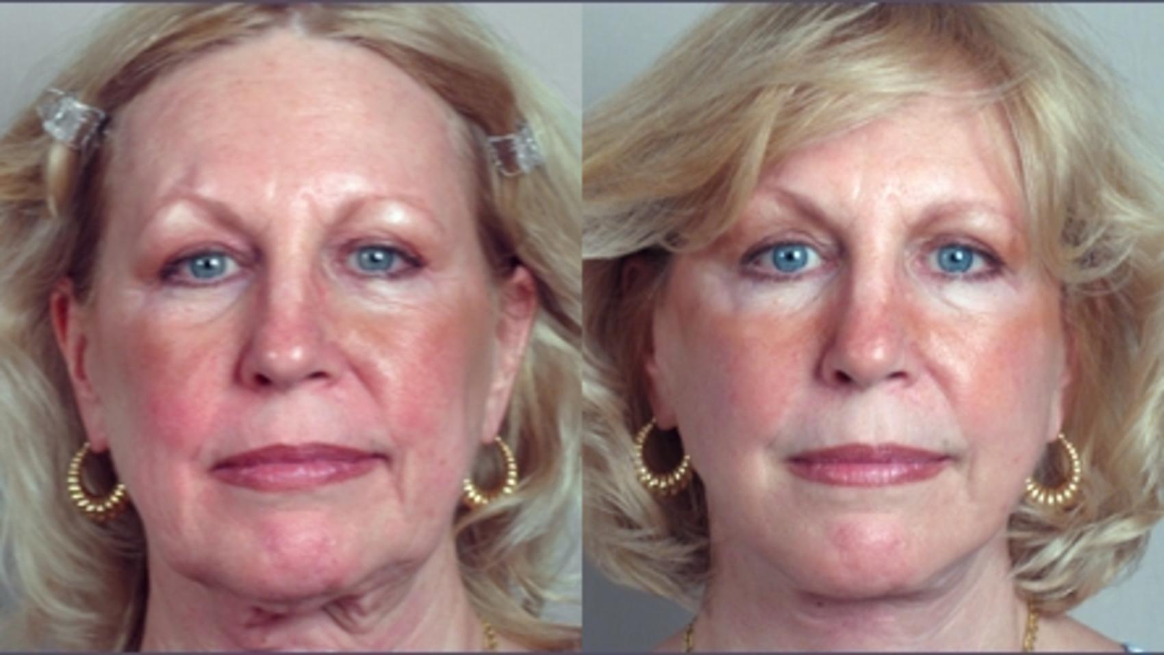 Facelift Case 8 Before & After View #1 | Paramus, New Jersey | Parker Center for Plastic Surgery