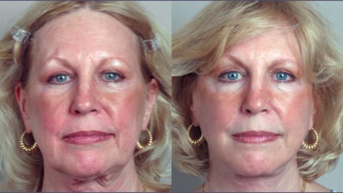 Facelift Case 8 Before & After View #1 | Paramus, New Jersey | Parker Center for Plastic Surgery