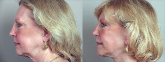 Facelift Case 8 Before & After View #2 | Paramus, New Jersey | Parker Center for Plastic Surgery