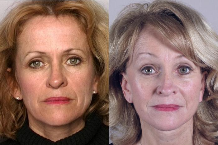 Facelift Case 847 Before & After front 10 year  | Paramus, New Jersey | Parker Center for Plastic Surgery