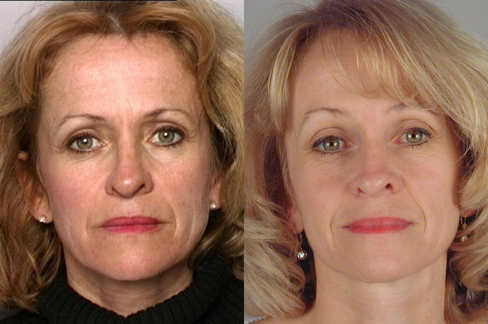 Facelift Case 847 Before & After Front | Paramus, New Jersey | Parker Center for Plastic Surgery