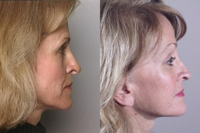 Facelift Case 847 Before & After left 10 year  | Paramus, New Jersey | Parker Center for Plastic Surgery