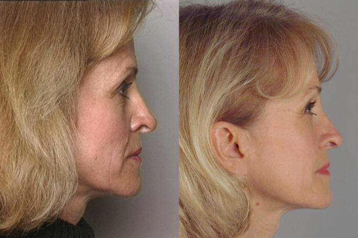 Facelift Case 847 Before & After Left Side | Paramus, New Jersey | Parker Center for Plastic Surgery