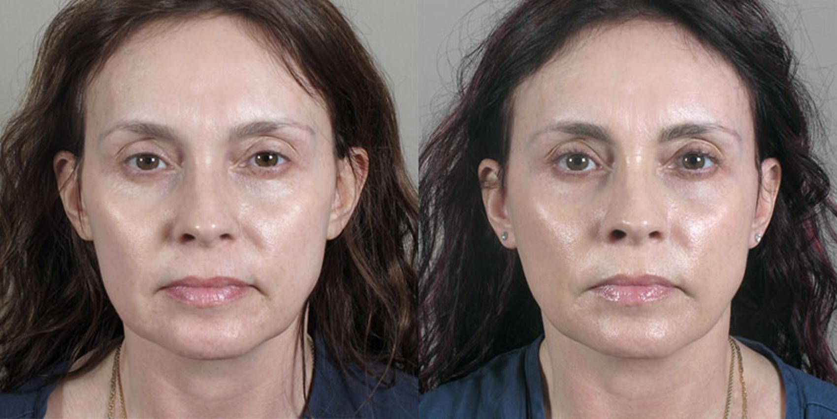 Fat Injection Case 29 Before & After View #1 | Paramus, New Jersey | Parker Center for Plastic Surgery