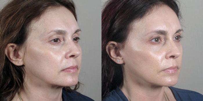 Fat Injection Case 29 Before & After View #2 | Paramus, New Jersey | Parker Center for Plastic Surgery