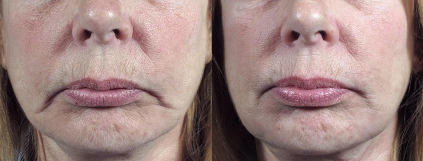 FaceTite Case 319 Before & After View #1 | Paramus, New Jersey | Parker Center for Plastic Surgery