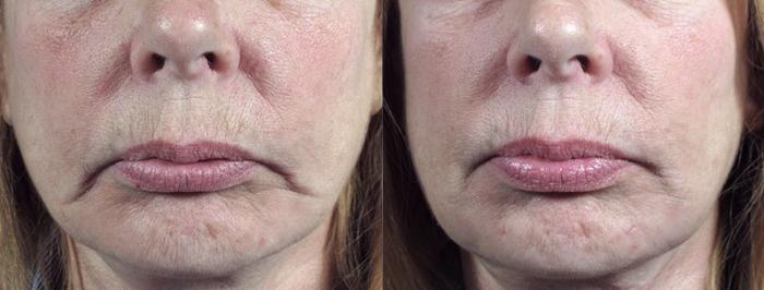 FaceTite Case 319 Before & After View #1 | Paramus, New Jersey | Parker Center for Plastic Surgery