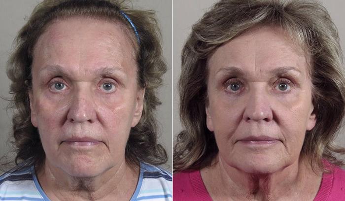 Fat Injection Case 345 Before & After View #1 | Paramus, New Jersey | Parker Center for Plastic Surgery