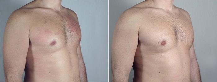 Fat Injection Case 661 Before & After View #1 | Paramus, New Jersey | Parker Center for Plastic Surgery