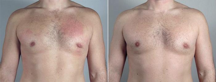 Fat Injection Case 661 Before & After View #2 | Paramus, New Jersey | Parker Center for Plastic Surgery