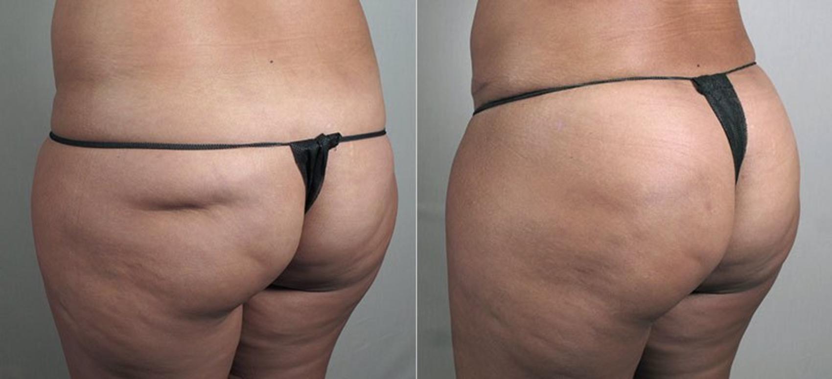 Fat Injection Case 812 Before & After View #1 | Paramus, New Jersey | Parker Center for Plastic Surgery