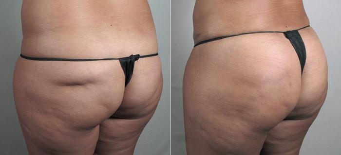 Fat Injection Case 812 Before & After View #1 | Paramus, New Jersey | Parker Center for Plastic Surgery