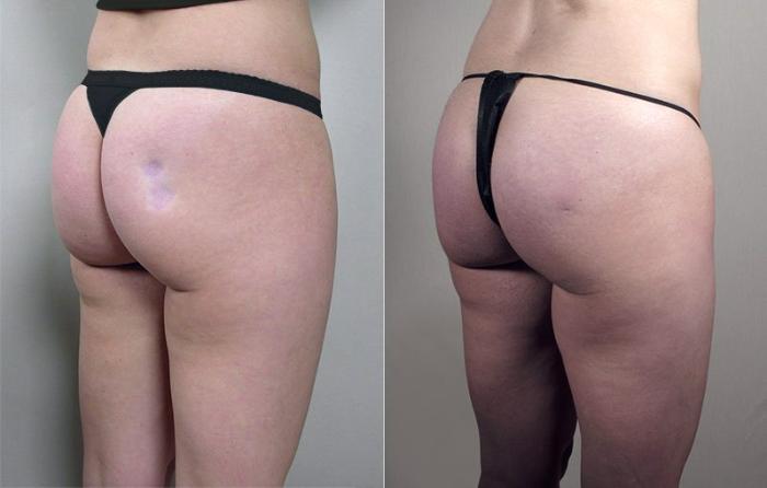Fat Injection Case 844 Before & After View #1 | Paramus, New Jersey | Parker Center for Plastic Surgery