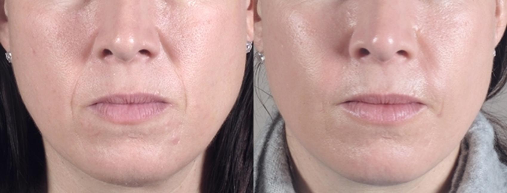 Fat Injection Case 958 Before & After View #5 | Paramus, New Jersey | Parker Center for Plastic Surgery