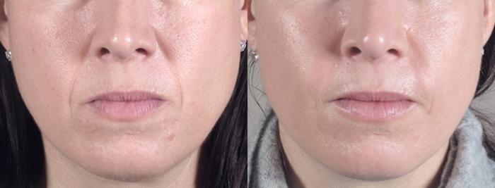 Fat Injection Case 958 Before & After View #5 | Paramus, New Jersey | Parker Center for Plastic Surgery