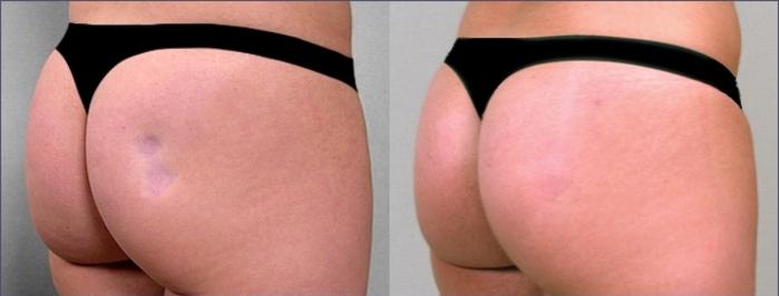 Fat Injection Case 959 Before & After View #5 | Paramus, New Jersey | Parker Center for Plastic Surgery