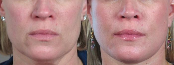Fat Injection Case 960 Before & After View #5 | Paramus, New Jersey | Parker Center for Plastic Surgery