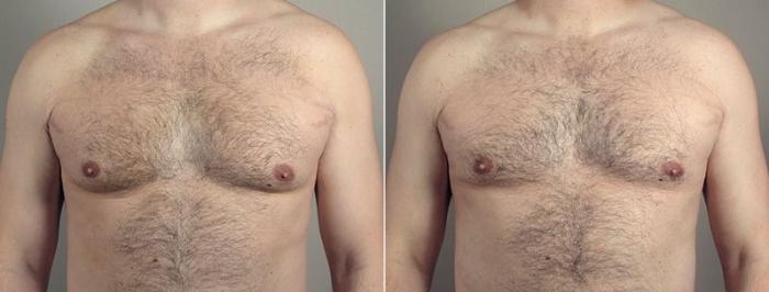 Gynecomastia Surgery Case 1296 Before & After Front | Paramus, New Jersey | Parker Center for Plastic Surgery