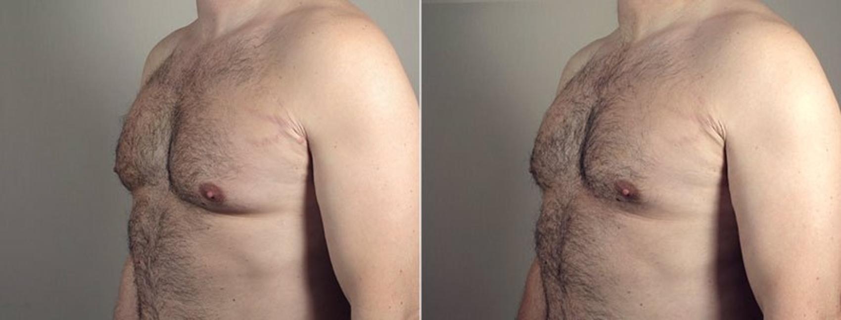 Gynecomastia Surgery Case 1296 Before & After Left Oblique | Paramus, New Jersey | Parker Center for Plastic Surgery