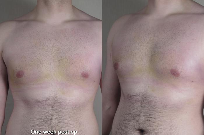 Gynecomastia Surgery Case 1368 Before & After 1 week  | Paramus, New Jersey | Parker Center for Plastic Surgery