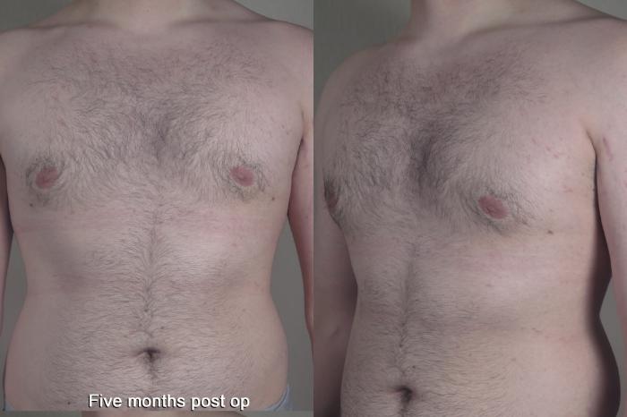 Gynecomastia Surgery Case 1368 Before & After months  | Paramus, New Jersey | Parker Center for Plastic Surgery