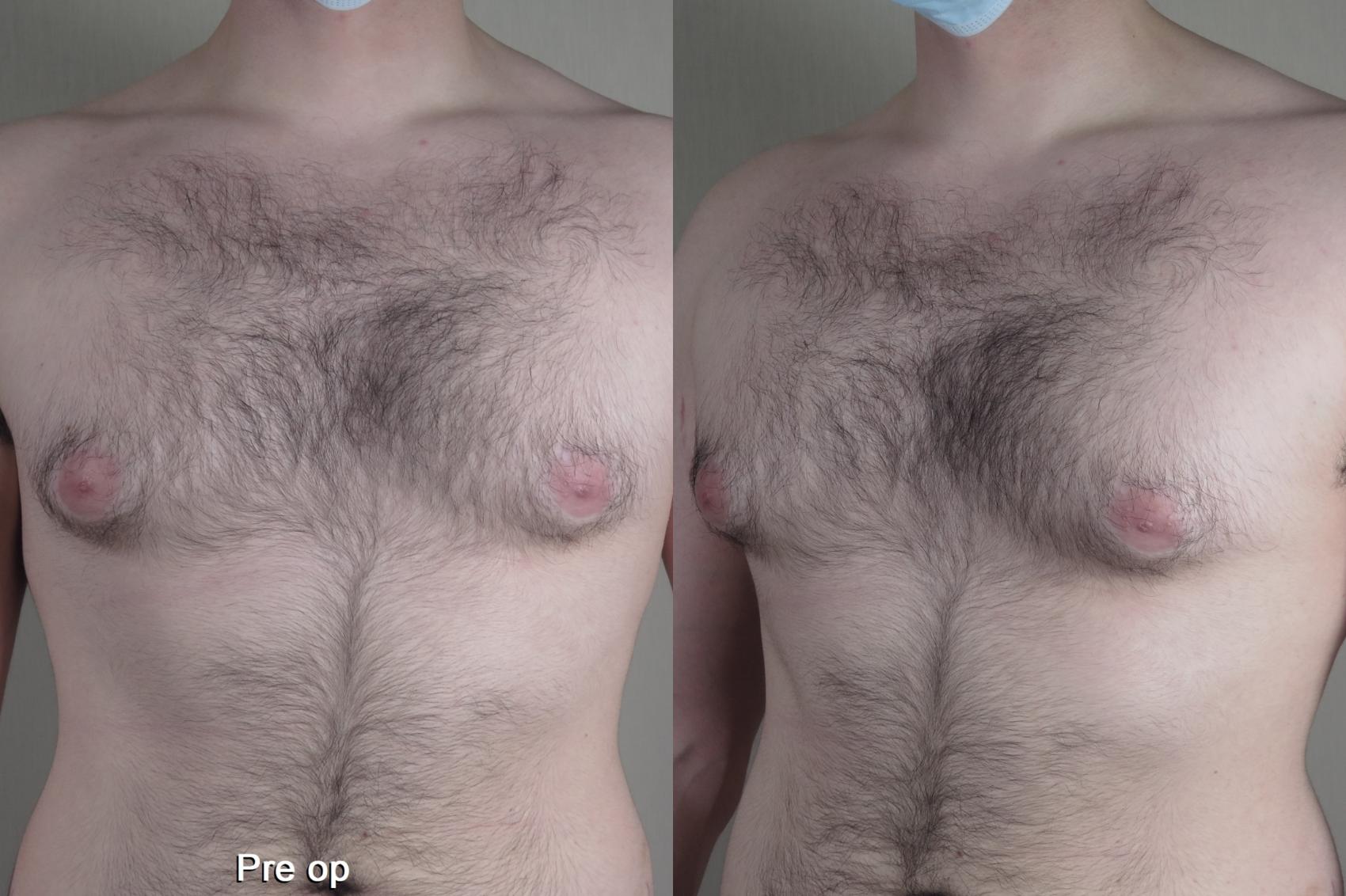 Gynecomastia Surgery Case 1368 Before & After pre op  | Paramus, New Jersey | Parker Center for Plastic Surgery