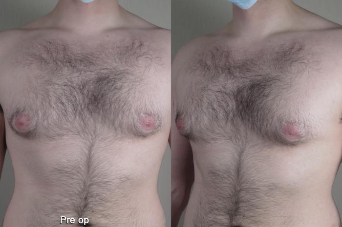 Gynecomastia Surgery Case 1368 Before & After pre op  | Paramus, New Jersey | Parker Center for Plastic Surgery