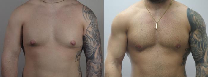 Gynecomastia Surgery Case 1631 Before & After Front | Paramus, New Jersey | Parker Center for Plastic Surgery