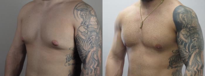 Gynecomastia Surgery Case 1631 Before & After Left Oblique | Paramus, New Jersey | Parker Center for Plastic Surgery