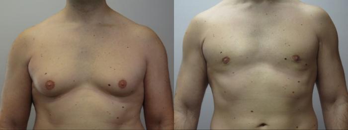 Gynecomastia Surgery Case 1644 Before & After Front | Paramus, New Jersey | Parker Center for Plastic Surgery