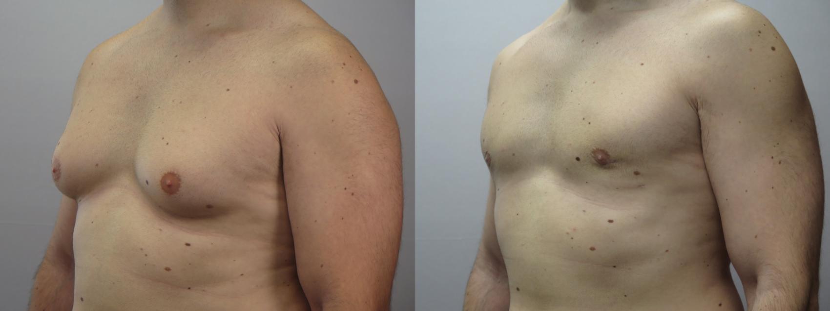 Gynecomastia Surgery Case 1644 Before & After Left Oblique | Paramus, New Jersey | Parker Center for Plastic Surgery