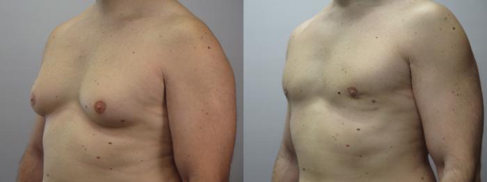 Gynecomastia Surgery Case 1644 Before & After Left Oblique | Paramus, New Jersey | Parker Center for Plastic Surgery