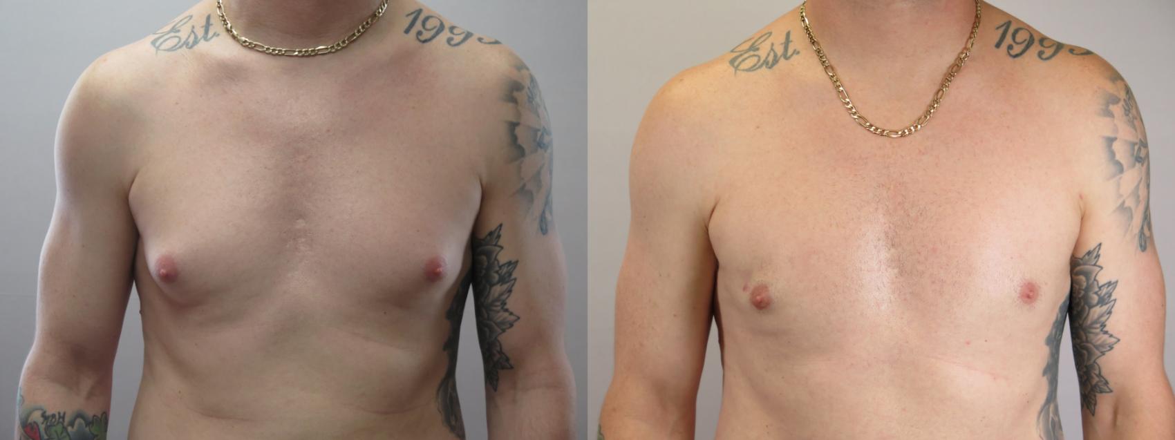 Gynecomastia Surgery Case 1671 Before & After Front | Paramus, New Jersey | Parker Center for Plastic Surgery