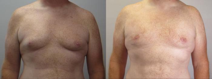Gynecomastia Surgery Case 1675 Before & After Front | Paramus, New Jersey | Parker Center for Plastic Surgery