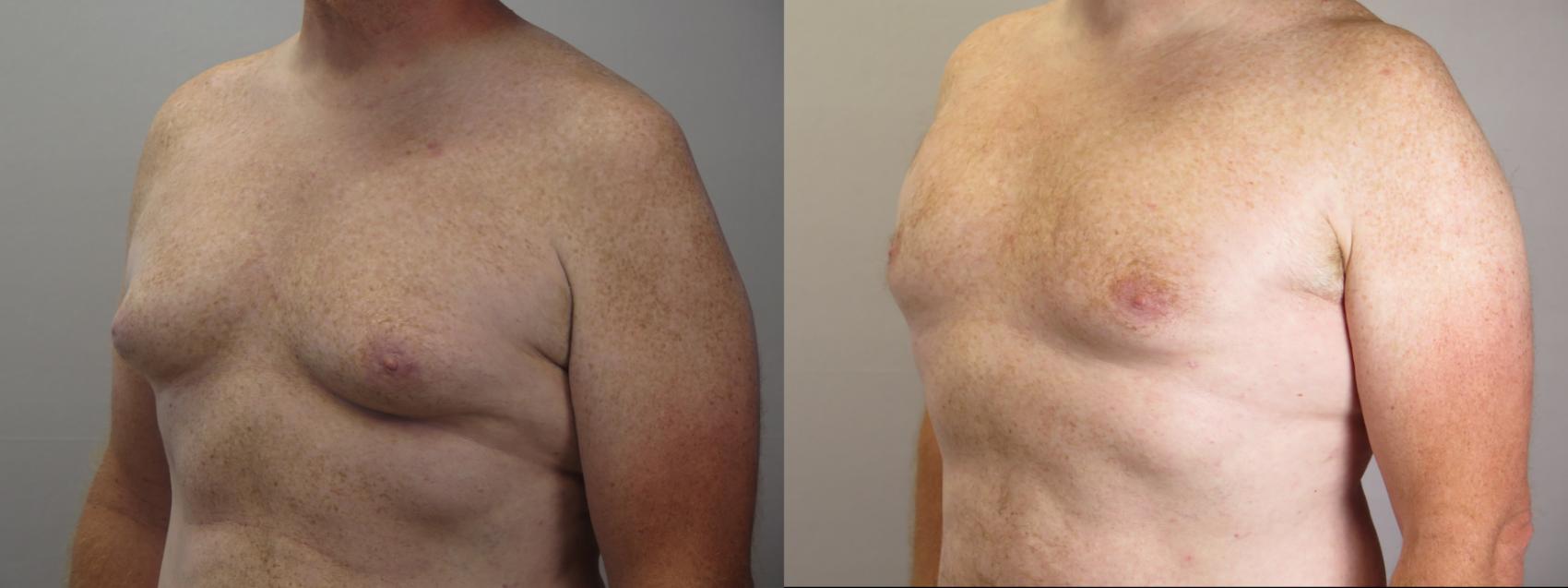 Gynecomastia Surgery Case 1675 Before & After Left Oblique | Paramus, New Jersey | Parker Center for Plastic Surgery