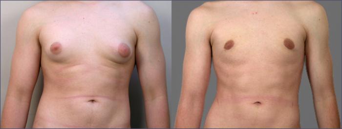 Gynecomastia Surgery Case 613 Before & After View #1 | Paramus, New Jersey | Parker Center for Plastic Surgery