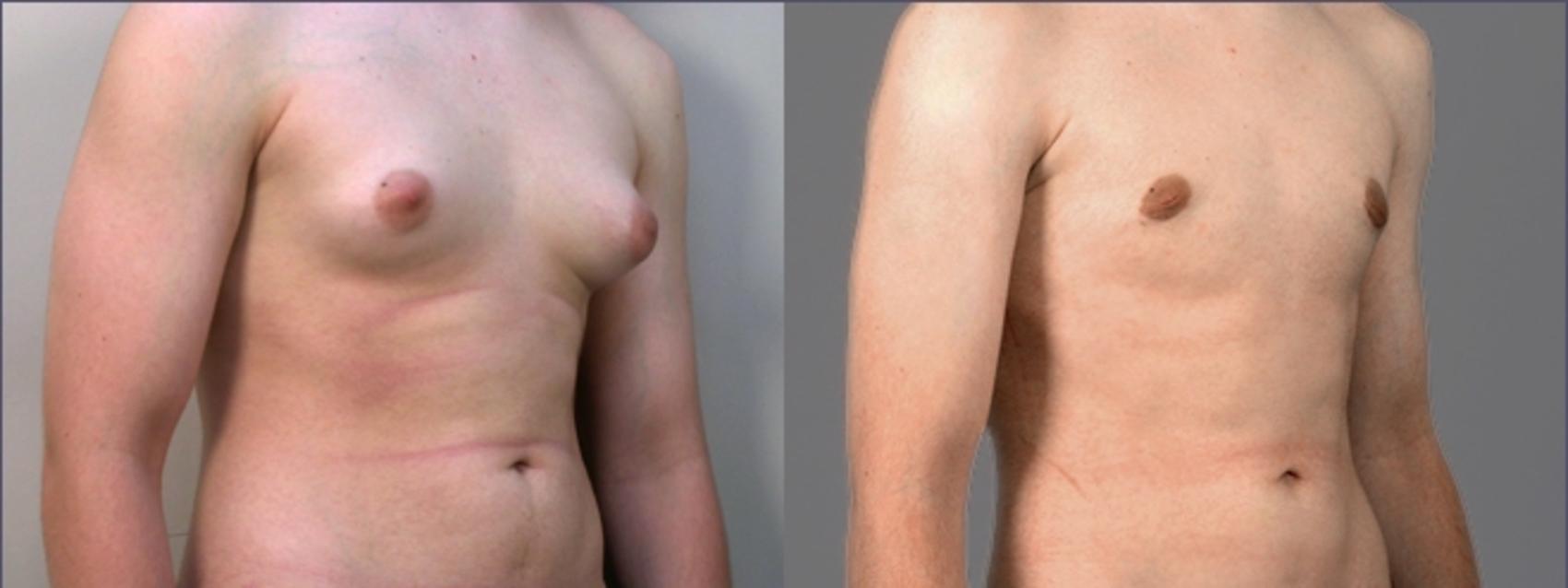 Gynecomastia Surgery Case 613 Before & After View #2 | Paramus, New Jersey | Parker Center for Plastic Surgery