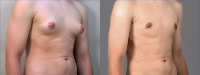 Gynecomastia Surgery Case 613 Before & After View #2 | Paramus, New Jersey | Parker Center for Plastic Surgery