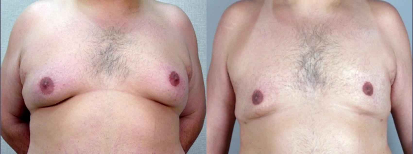 Gynecomastia Surgery Case 614 Before & After View #1 | Paramus, New Jersey | Parker Center for Plastic Surgery