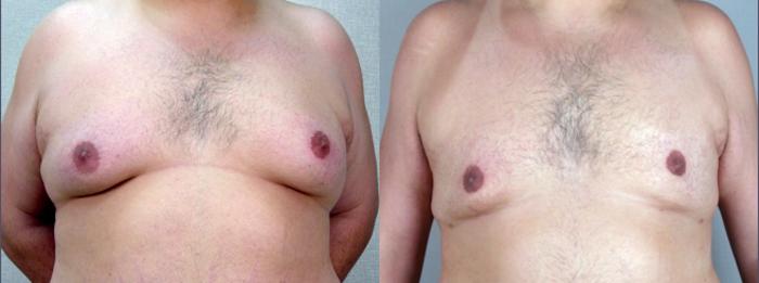 Gynecomastia Surgery Case 614 Before & After View #1 | Paramus, New Jersey | Parker Center for Plastic Surgery