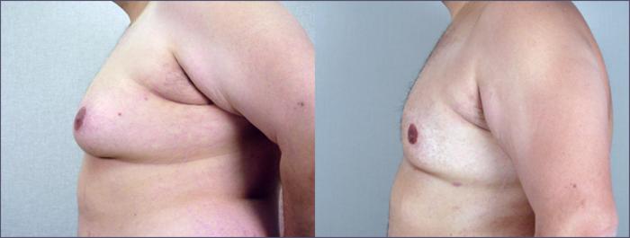 Gynecomastia Surgery Case 614 Before & After View #2 | Paramus, New Jersey | Parker Center for Plastic Surgery