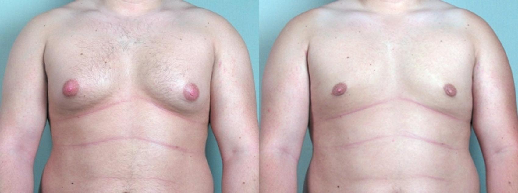 Gynecomastia Surgery Case 616 Before & After View #1 | Paramus, New Jersey | Parker Center for Plastic Surgery