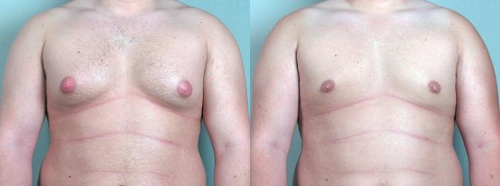Gynecomastia Surgery Case 616 Before & After View #1 | Paramus, New Jersey | Parker Center for Plastic Surgery