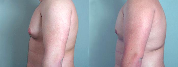 Gynecomastia Surgery Case 616 Before & After View #2 | Paramus, New Jersey | Parker Center for Plastic Surgery
